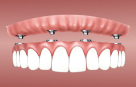 Complete-Flexible-Dentures.png